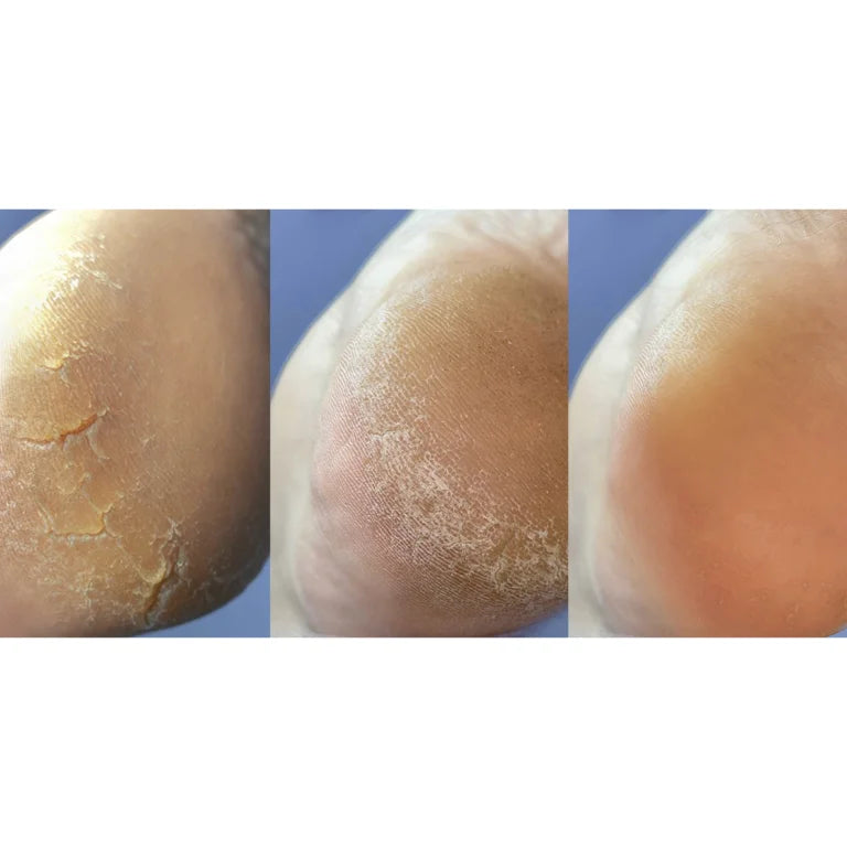 NAILSOFTHEDAY ONISTOP Podology+ CREAM to Heal Cracks on The Skin of Hands and Feet