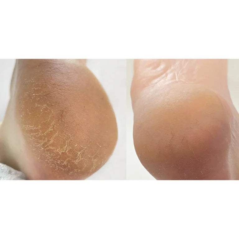 NAILSOFTHEDAY ONISTOP Podology+ CREAM to Heal Cracks on The Skin of Hands and Feet